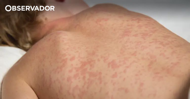 Sarampo em Portugal: 14 Casos Registrados Desde o Início do Ano, Alerta para Disseminação